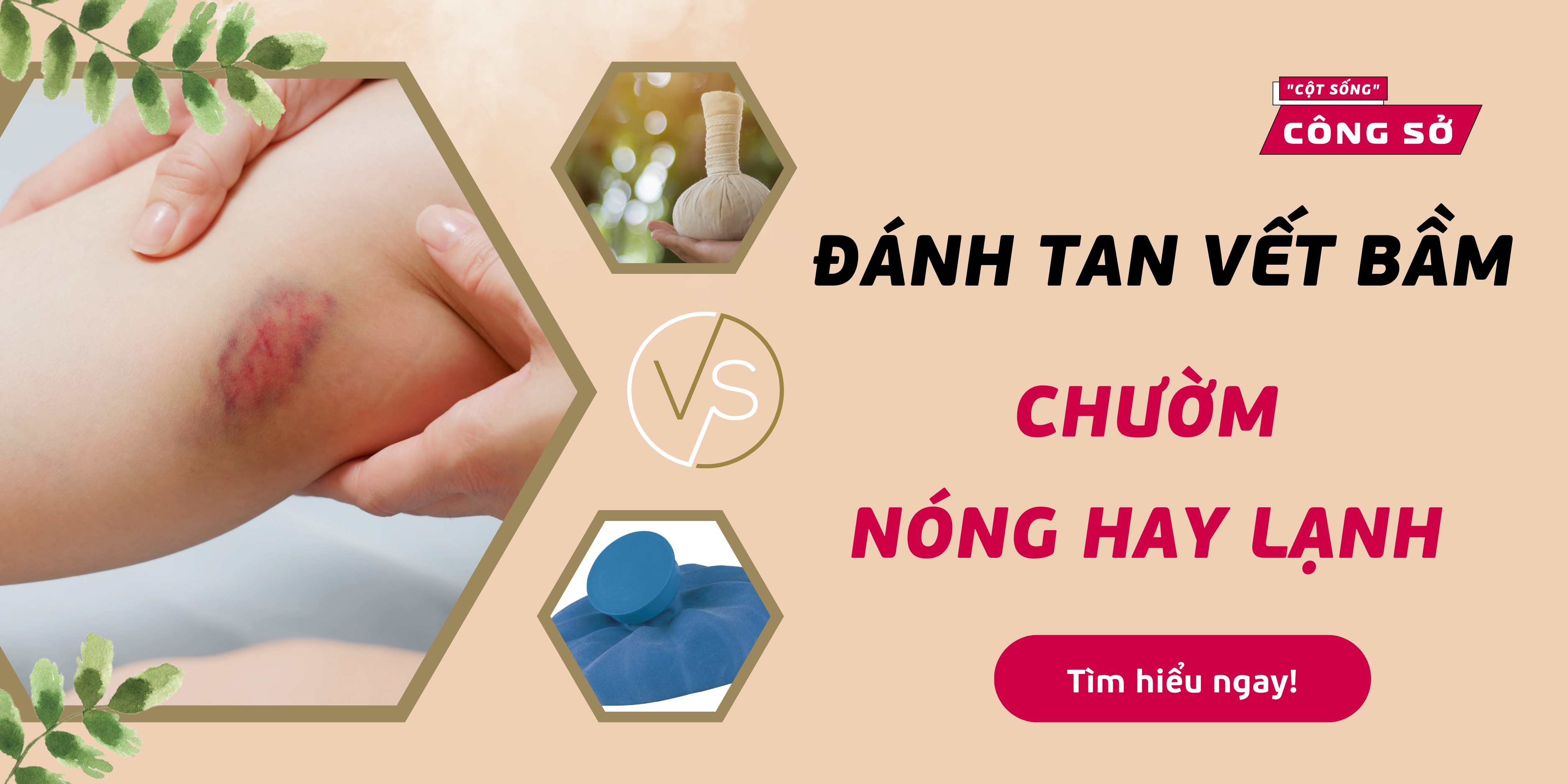Đánh tan vết bầm - Chườm đá hay chườm ấm?